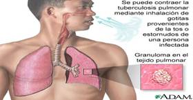 Tuberculosis pulmonar